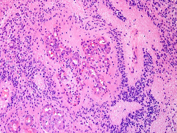 10N3 Ependymoma, anaplastic (Case 10N) H&E 9.jpg