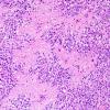 10O1 Ependymoma, WHO II (Case 10O) H&E.jpg