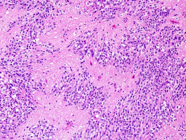 10O1 Ependymoma, WHO II (Case 10O) H&E.jpg