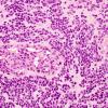 10P Ependymoma, Anaplastic (Case 10P) H&E 1