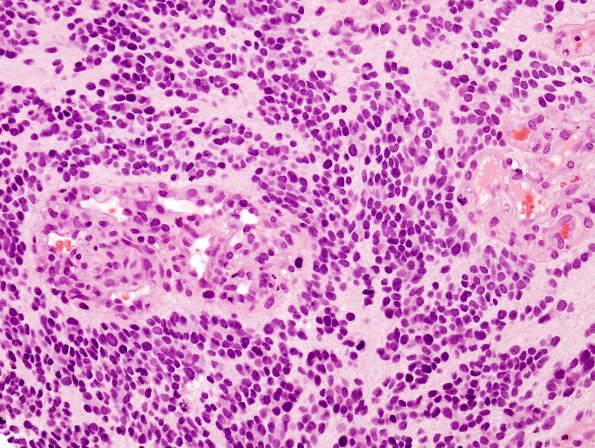 10P Ependymoma, Anaplastic (Case 10P) H&E 1