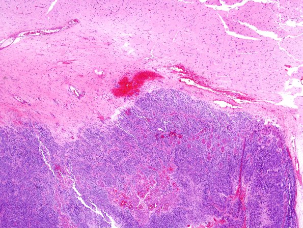 10Q1 Ependymoma, anaplastic (Case 10Q) H&E 6