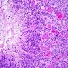 10Q2 Ependymoma, Gr 3, recurrent (Case 10Q) 8.jpg