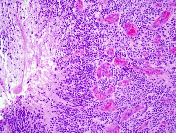 10Q2 Ependymoma, Gr 3, recurrent (Case 10Q) 8.jpg