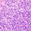 10Q3 Ependymoma, anaplastic (Case 10Q) H&E 4