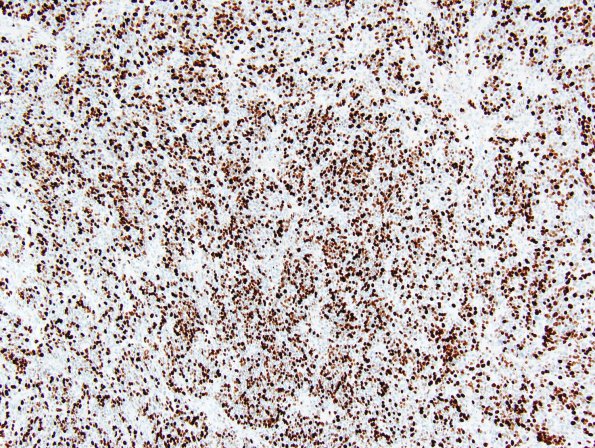 10Q4 Ependymoma, Gr 3, recurrent (Case 10Q) Ki-67 1.jpg