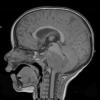 10R1 Ependymoma, anaplastic WHO III (Case 10R) T1 - Copy