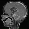 10R2 Ependymoma, anaplastic WHO III (Case 10R) T1 W 3 - Copy