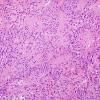 10R3 Ependymoma, anaplastic WHO III (Case 10R) H&E 2.jpg