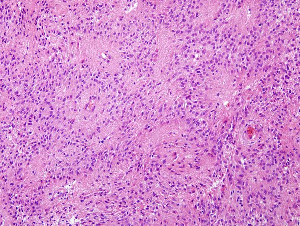 10R3 Ependymoma, anaplastic WHO III (Case 10R) H&E 2.jpg