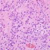 10R4 Ependymoma, anaplastic WHO III (Case 10R) H&E 3.jpg