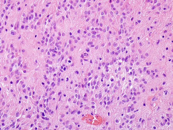 10R4 Ependymoma, anaplastic WHO III (Case 10R) H&E 3.jpg