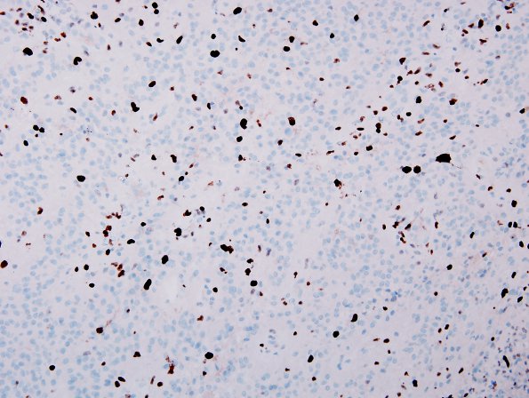 10R5 Ependymoma, anaplastic WHO III (Case 10R) Ki67.jpg