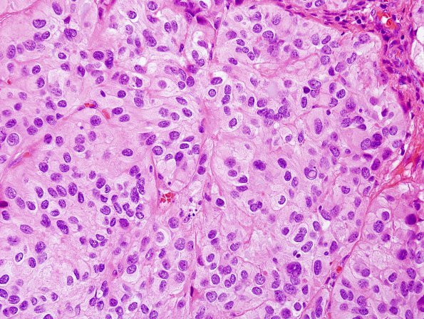 10S2 Ependymoma, anaplastic (Case 10S) H&E 8.jpg