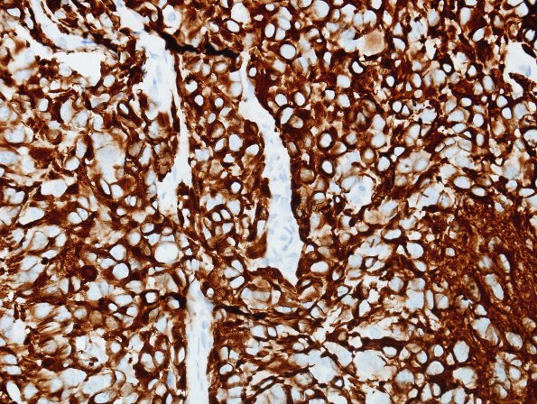 10S3 Ependymoma, anaplastic (Case 10S) GFAP.jpg