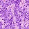 10T1 Ependymoma, anaplastic (Case 10T) H&E 1.jpg