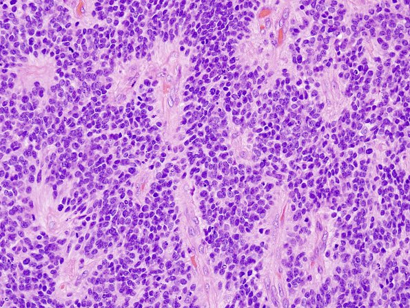 10T1 Ependymoma, anaplastic (Case 10T) H&E 1.jpg