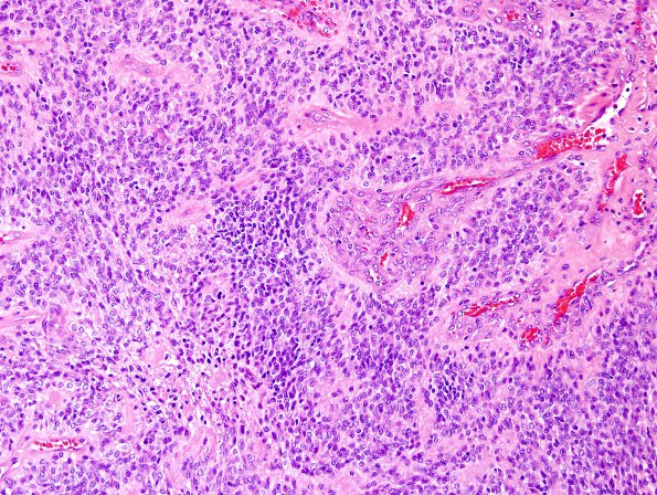 10T2 Ependymoma, anaplastic (Case 10T) H&E 3.jpg