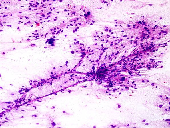 10U1 Ependymoma, anaplastic (Case 10U) H&E smear.jpg