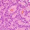 10U2 Ependymoma, anaplastic (Case 10U) H&E 2.jpg