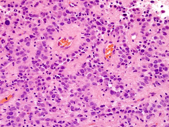 10U2 Ependymoma, anaplastic (Case 10U) H&E 2.jpg