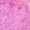 10U3 Ependymoma, anaplastic (Case 10U) H&E 1.jpg