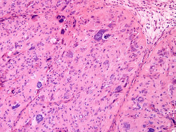 10U3 Ependymoma, anaplastic (Case 10U) H&E 1.jpg