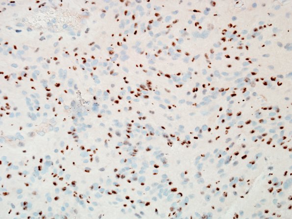 10U4 Ependymoma, anaplastic (Case 10U) D2-40 2.jpg