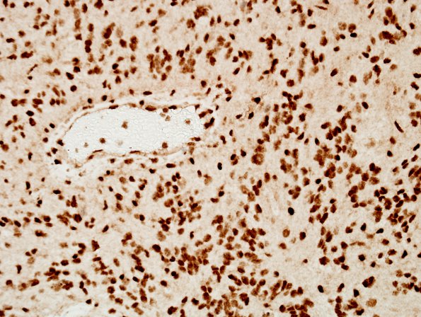 10U5 Ependymoma, anaplastic (Case 10U) ATRX 2.jpg