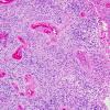 10V1 Ependymoma, anaplastic (Case 10V) 1.jpg