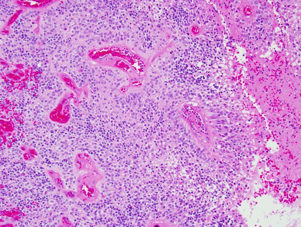 10V1 Ependymoma, anaplastic (Case 10V) 1.jpg