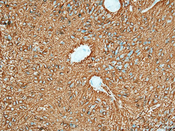 10V2 Ependymoma, anaplastic (Case 10V) GFAP 1.jpg