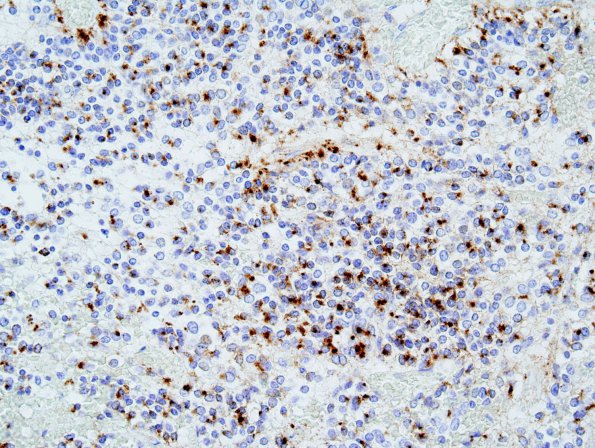 10V3 Ependymoma, anaplastic (Case 10V) EMA 1.jpg