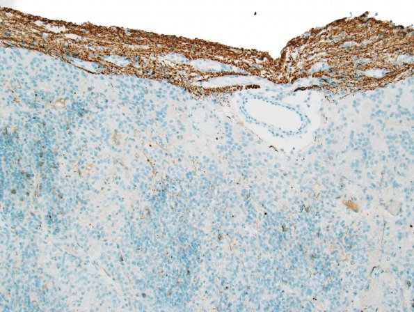 10V4 Ependymoma, anaplastic (Case 10V) NFP 2.jpg