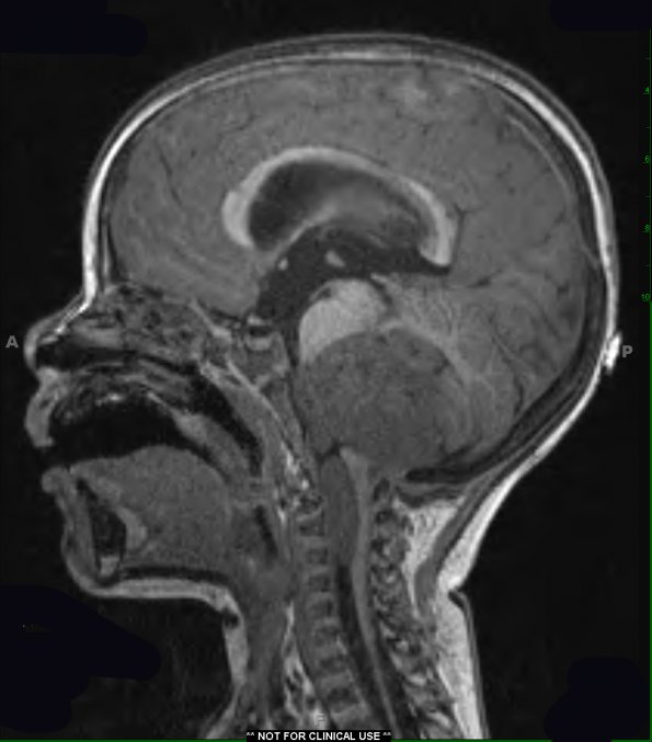 11A1 Ependymoma, anaplastic (Case 11) T1 MPRAGE - Copy - Copy