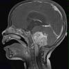 11A2 Ependymoma, anaplastic (Case 11) T1 W 1 - Copy - Copy