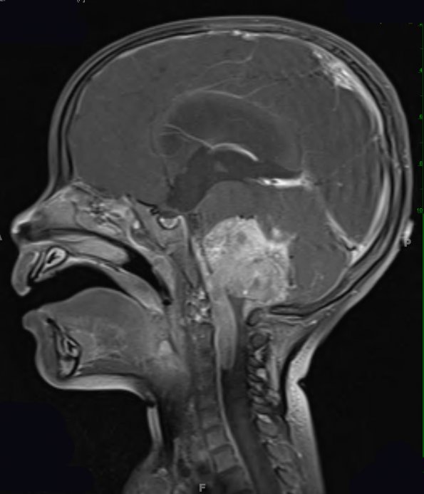 11A2 Ependymoma, anaplastic (Case 11) T1 W 1 - Copy - Copy