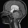 11A3 Ependymoma, anaplastic (Case 11) T2 3 - Copy - Copy