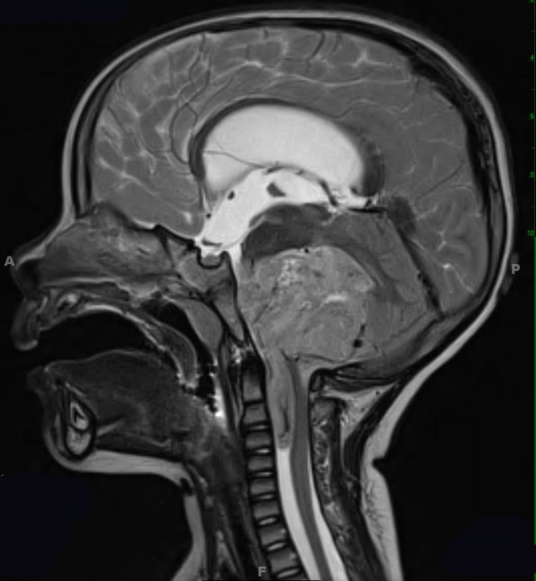 11A3 Ependymoma, anaplastic (Case 11) T2 3 - Copy - Copy