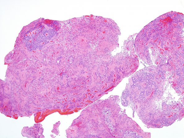 11B1 Ependymoma, anaplastic (Case 11) H&E 1