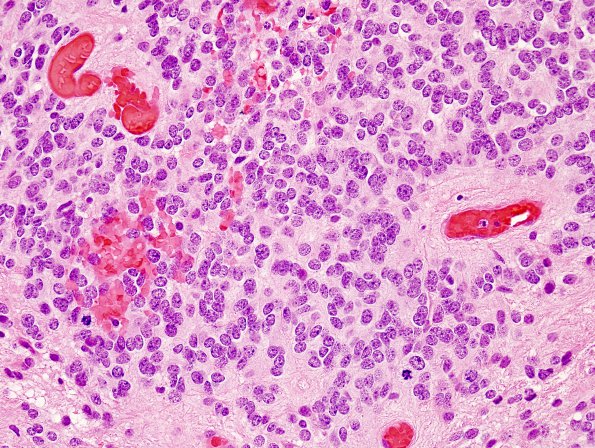 11B2 Ependymoma, anaplastic (Case 11) H&E 4