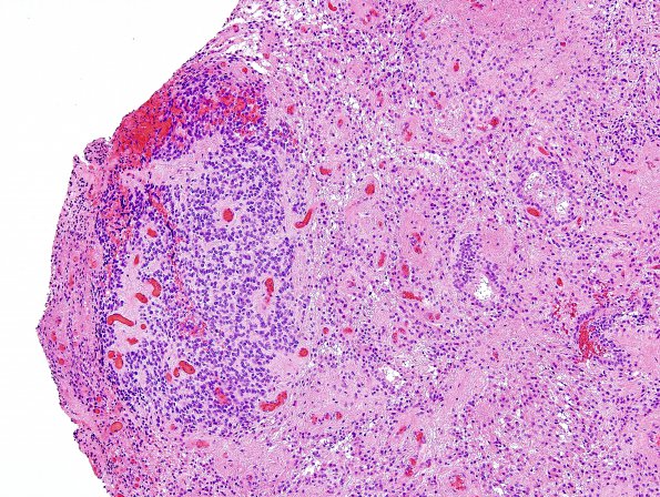 11B3 Ependymoma, anaplastic (Case 11) H&E 2