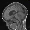 12A1 Ependymoma, anaplastic (Case 12) T1 2 - Copy