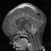 12A2 Ependymoma, anaplastic (Case 12) T1 W - Copy