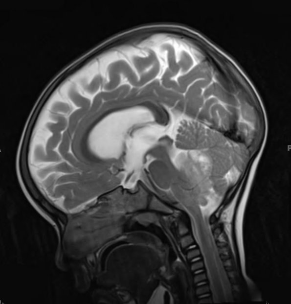 12A3 Ependymoma, anaplastic (Case 12) T2 1 - Copy