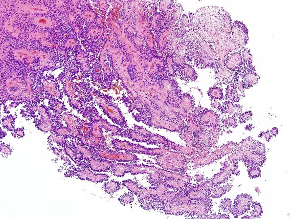 12B1 Ependymoma, anaplastic (Case 12) H&E 10