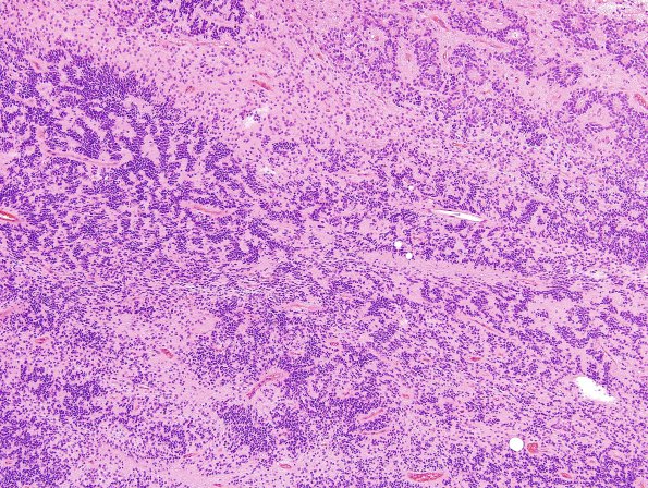 12B2 Ependymoma, anaplastic (Case 12) H&E 9