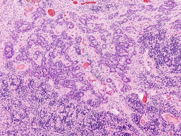 12B3 Ependymoma, anaplastic (Case 12) H&E 1