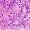 12B4 Ependymoma, anaplastic (Case 12) H&E 7