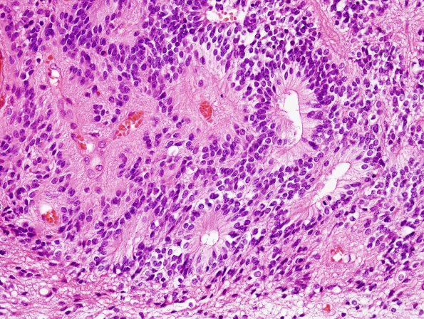 12B4 Ependymoma, anaplastic (Case 12) H&E 7